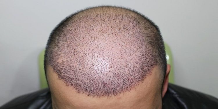 معروف ترین کلینیک کاشت مو طبیعی در فردیس