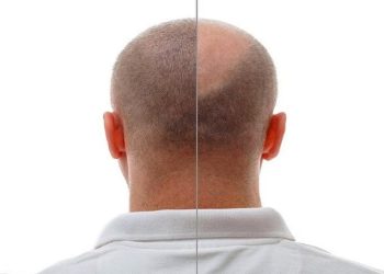 کاشت مو طبیعی در فلکه اول فردیس