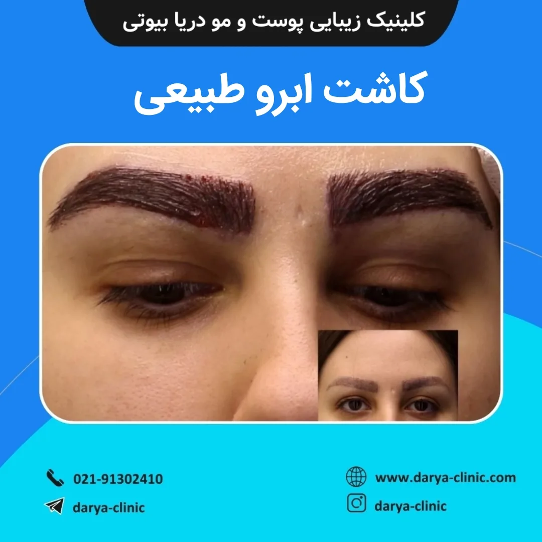 کاشت ابرو طبیعی