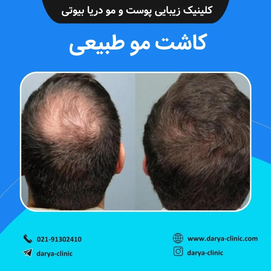 کاشت مو طبیعی